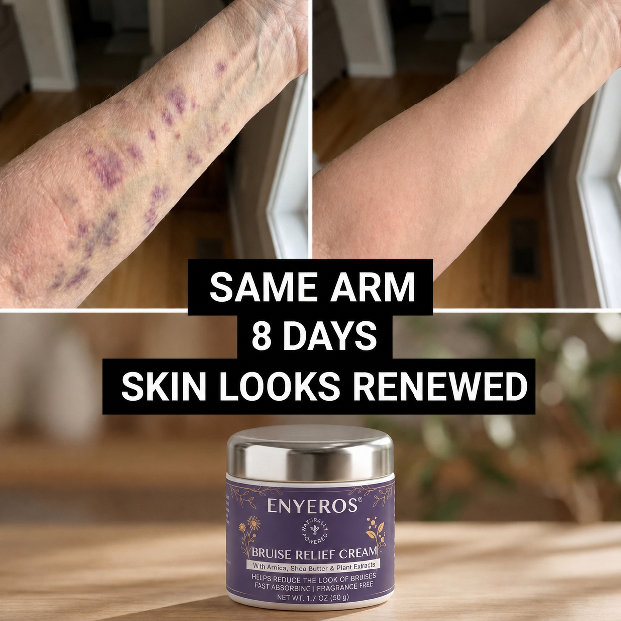 💜 100,000+ UNITS SOLD 💁‍♀️ – ENYEROS® Bruise Relief & Skin-Strengthening Cream