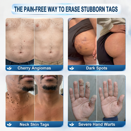 🏥👩‍⚕️NEYEROS®✨ 𝟕-𝐃𝒂𝘆 𝐒𝗸𝐢𝐧 𝐓𝒂𝗴 & 𝐒𝐩𝙤𝐭 𝐄𝐫𝒂𝐬𝙚𝐫 𝐏𝐚𝐢𝐧𝐥𝐞𝐬𝐬 & 𝐒𝐜𝐚𝐫-𝐅𝐫𝐞𝐞 𝐀𝐝𝐯𝐚𝐧𝐜𝐞𝐝 𝐈𝐦𝐩𝐞𝐫𝐟𝐞𝐜𝐭𝐢𝐨𝐧 𝐑𝐞𝐦𝐨𝐯𝐚𝐥 𝐑𝐨𝐥𝐥𝐞𝐫𝐛𝐚𝐥𝐥 𝐏𝐞𝐧