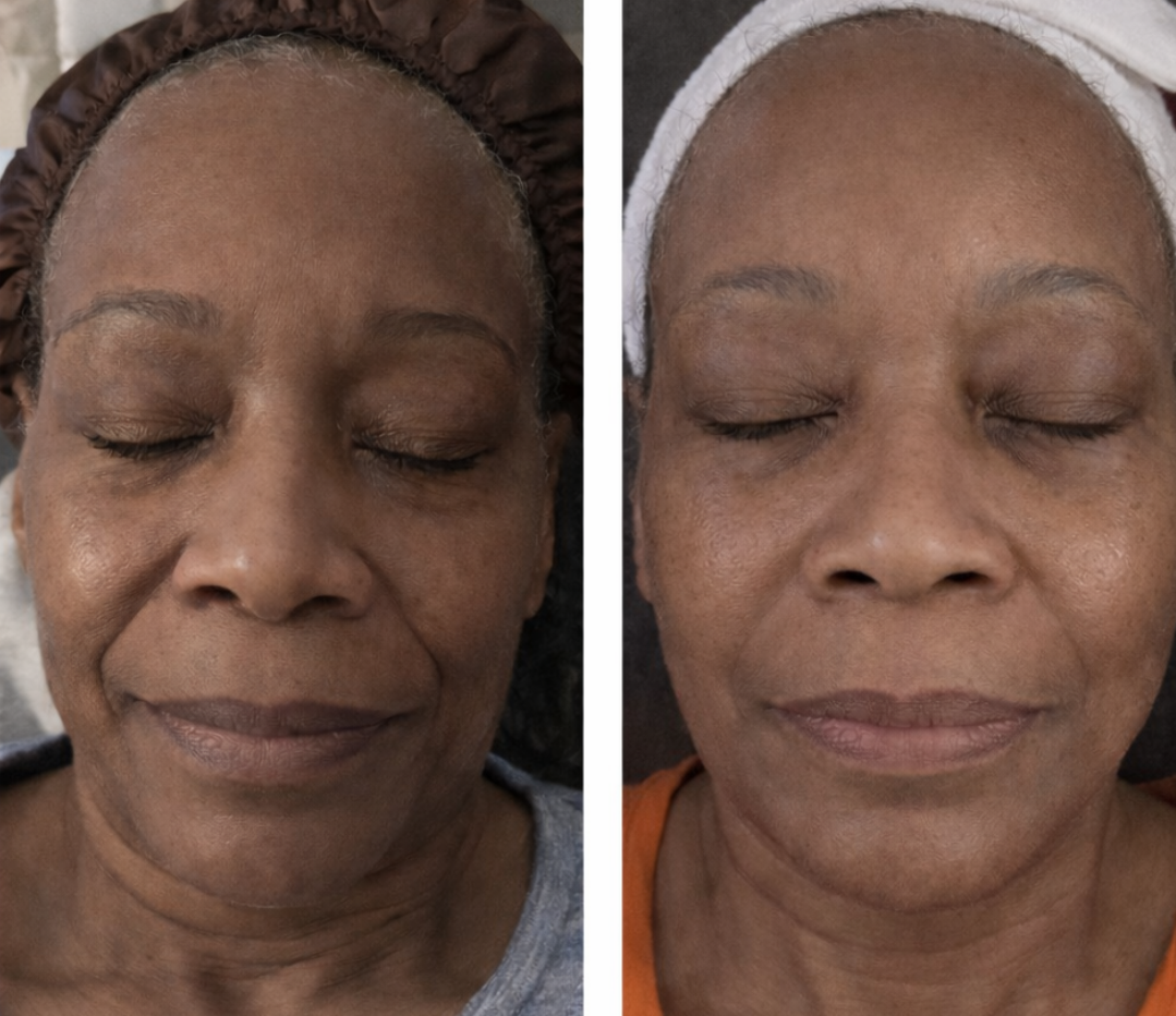 NEYEROS™ Collagen Peptide Lifting Ampoule