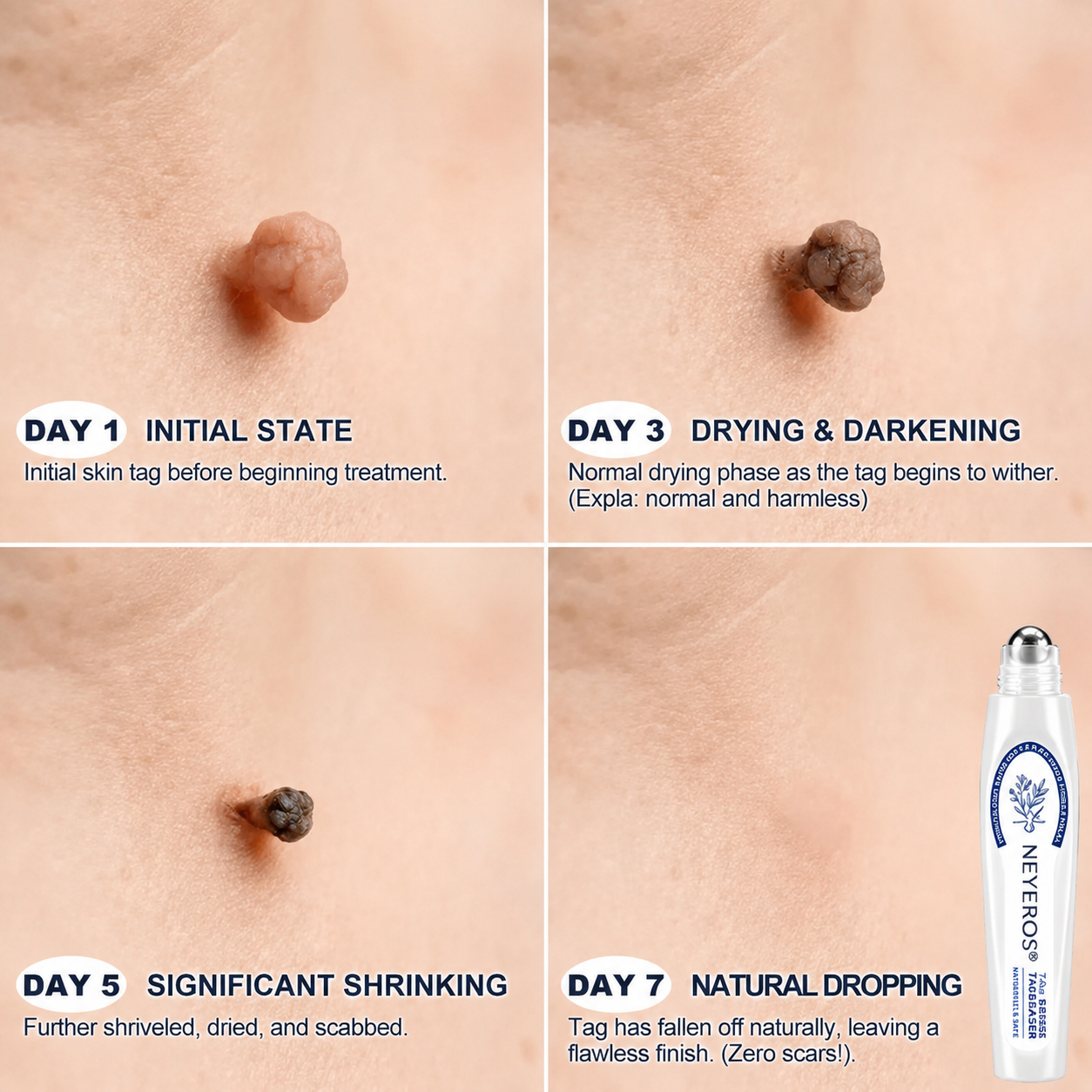 🏥👩‍⚕️NEYEROS®✨ 𝟕-𝐃𝒂𝘆 𝐒𝗸𝐢𝐧 𝐓𝒂𝗴 & 𝐒𝐩𝙤𝐭 𝐄𝐫𝒂𝐬𝙚𝐫 𝐏𝐚𝐢𝐧𝐥𝐞𝐬𝐬 & 𝐒𝐜𝐚𝐫-𝐅𝐫𝐞𝐞 𝐀𝐝𝐯𝐚𝐧𝐜𝐞𝐝 𝐈𝐦𝐩𝐞𝐫𝐟𝐞𝐜𝐭𝐢𝐨𝐧 𝐑𝐞𝐦𝐨𝐯𝐚𝐥 𝐑𝐨𝐥𝐥𝐞𝐫𝐛𝐚𝐥𝐥 𝐏𝐞𝐧